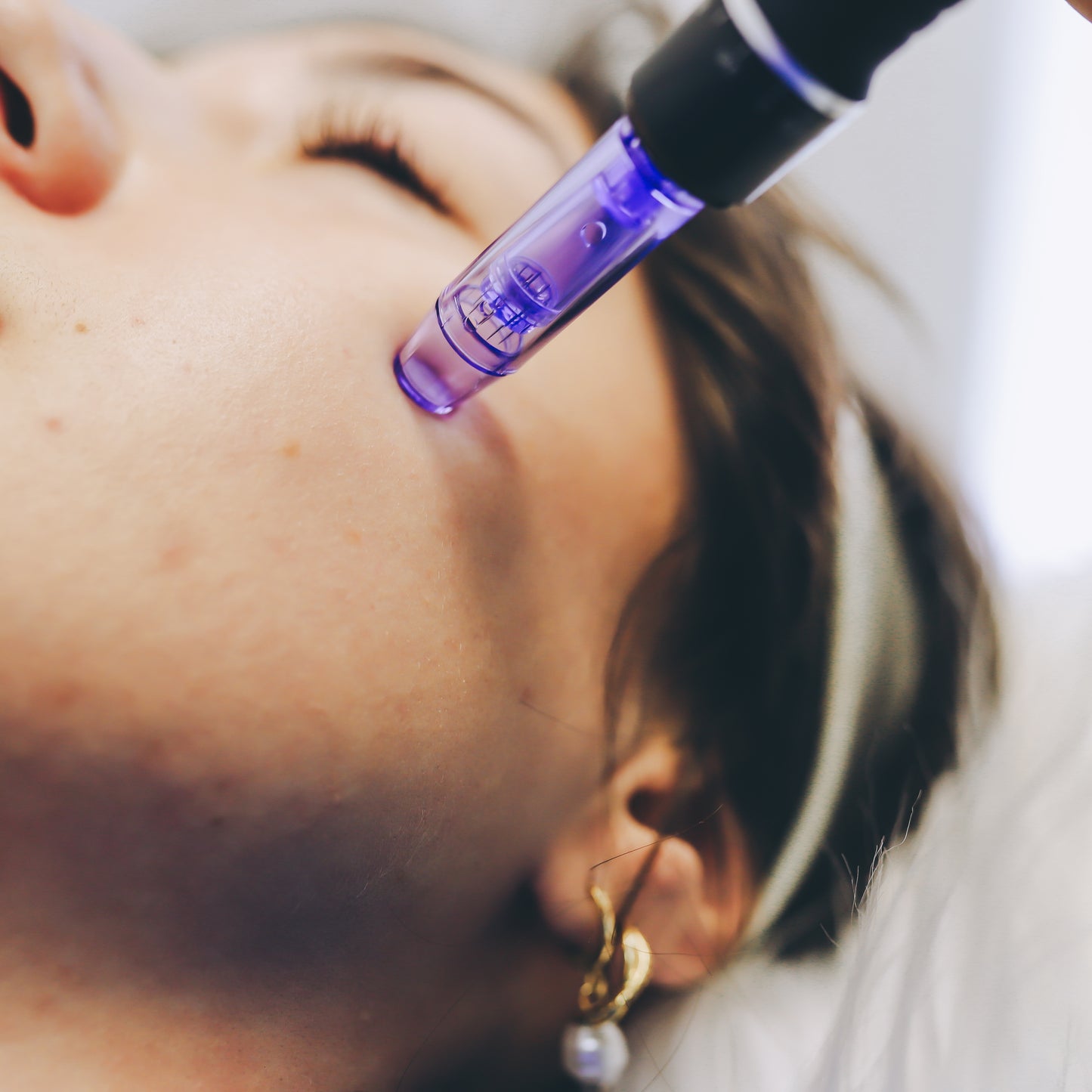 Microneedling
